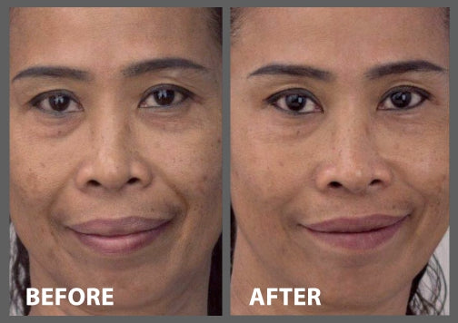 Before and after comparison of a person's face with visible skin improvement.