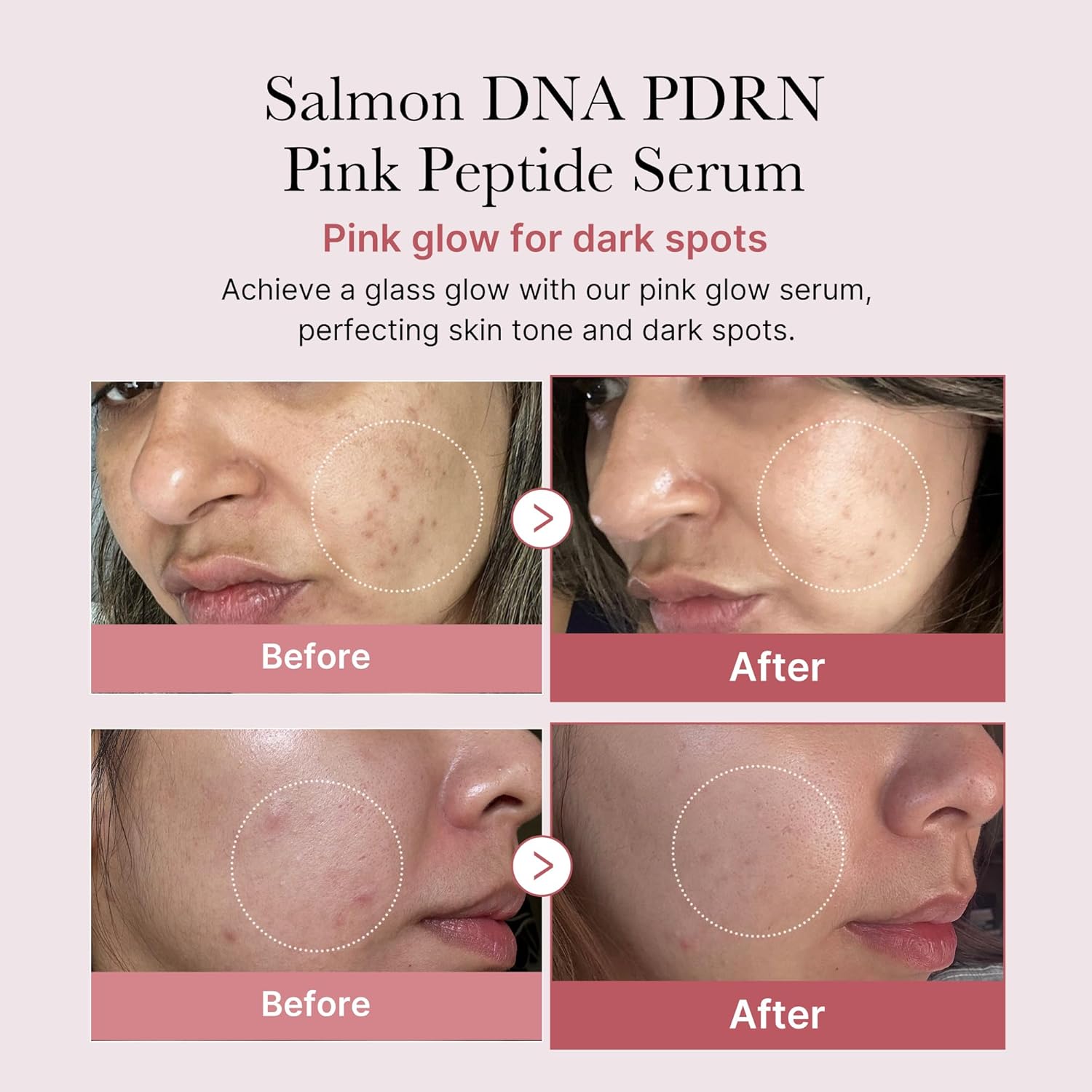 Before and after effects of Salmon DNA PDRN Pink Peptide Serum on skin with dark spots.