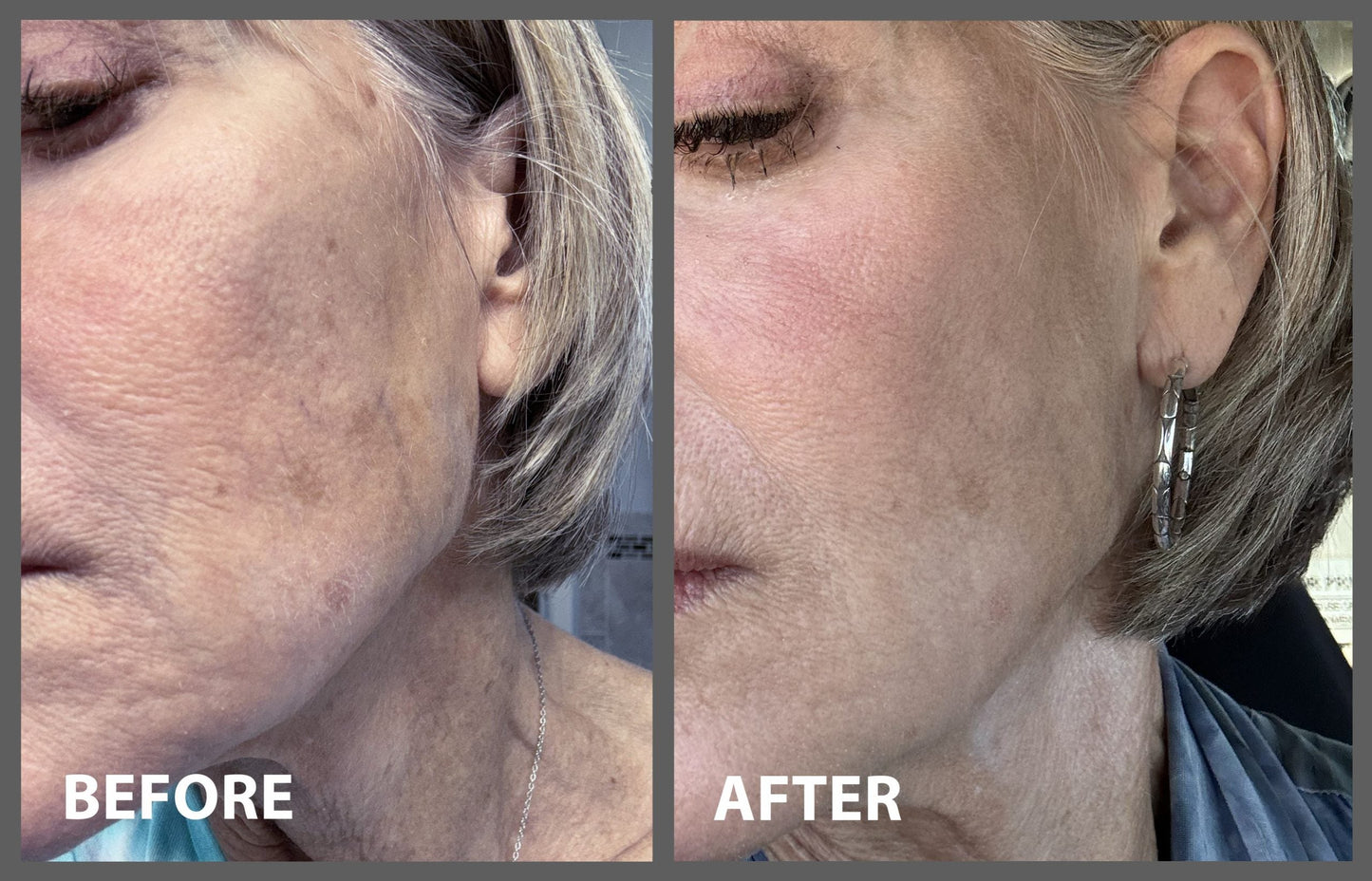 Before and after comparison of a person's face with visible skin texture changes.